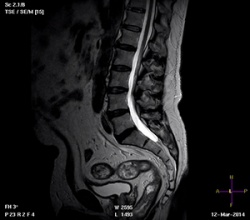 Магнитно-резонансная томография (МРТ) позвоночника