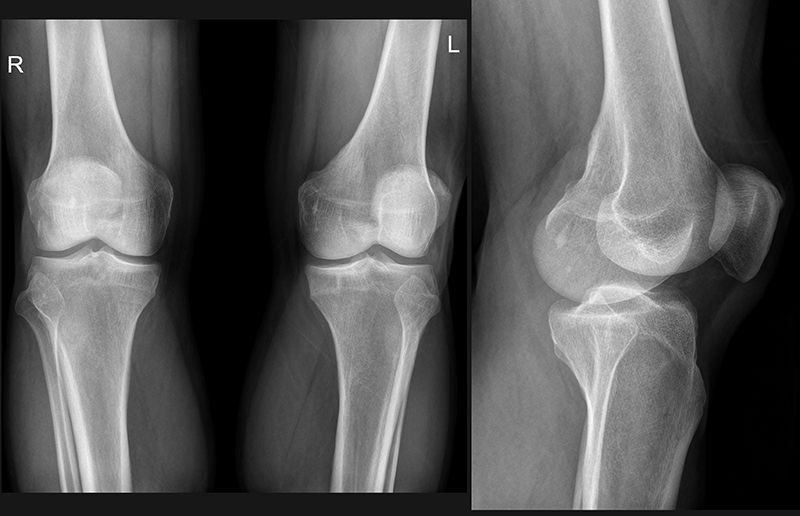 Как и для чего проводят рентген коленного сустава?