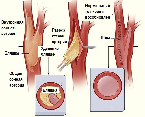  Атеросклероз 