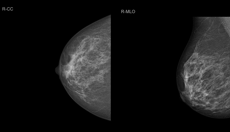 Маммография оренбург. Рентген молочных желез маммография. Рентген молочных желез маммография аппарат. Мастопатия на маммографии. Области молочной железы маммография.