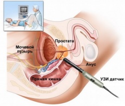 ТРУЗИ (трансректальное ультразвуковое исследование)