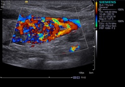 Ультразвуковое исследование (УЗИ) щитовидной железы