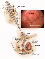 Уретроцистоскопия
